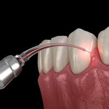 Advanced Laser Dentistry